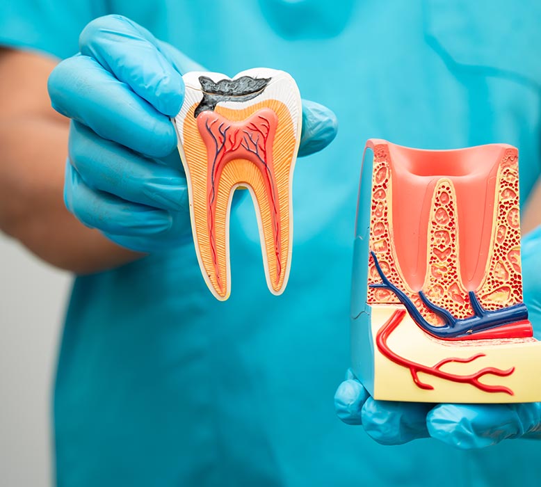 Root Canals